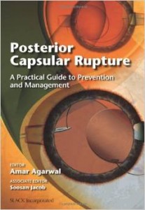 posterior capsular rupture 207x3001 1
