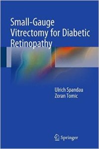 small gauge vitrectomy for diabetic retinopathy 199x3001 1