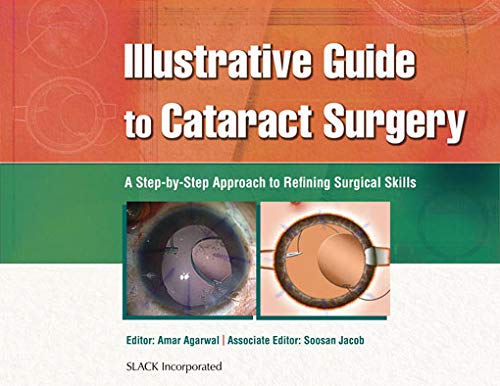 Illustrative Guide to Cataract Surgery A Step by Step Approach to Refining Surgical Skills