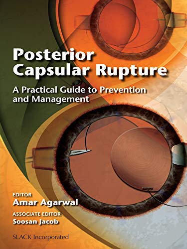 Posterior Capsular Rupture A Practical Guide to Prevention and Management
