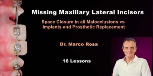 missing maxillary lateral incisors 600x300 1