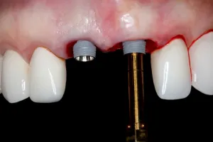 online residency program a z in implant dentistry 2022
