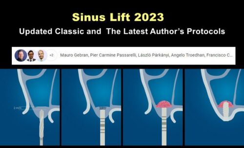sinus lift 2023 updated classic and the latest authors protocols 1